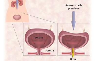 La vescica iperattiva: 10 trattamenti naturali per eliminare le perdite