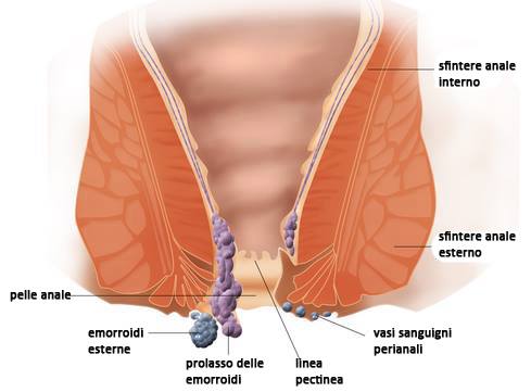 emorroidi