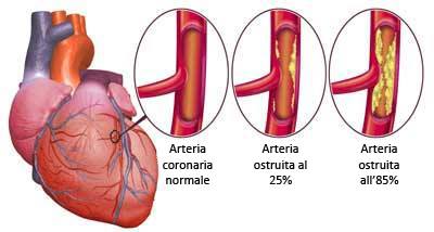 arteria ostruita e arteria normale