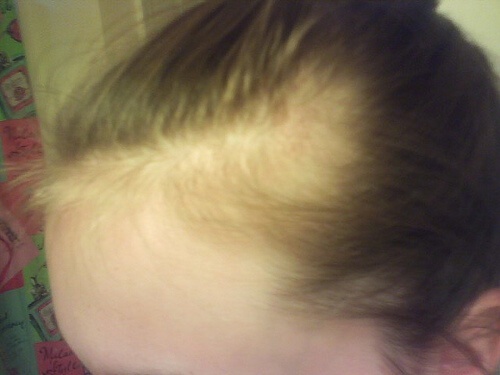 Alopecia