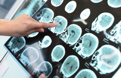 Evitare l'Alzheimer grazie a una sana alimentazione