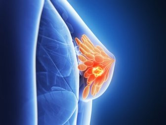 Si potrà predire il cancro al seno