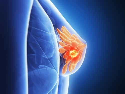 cancro al seno