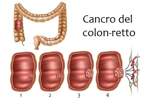 cancro al colon retto