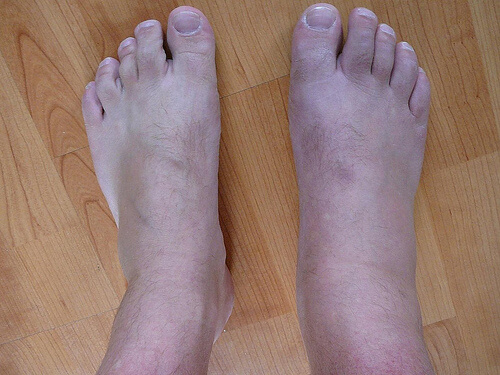 sono molte le cause che possono portare all'infiammazione delle caviglie