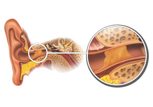 Pulire le orecchie dal cerume
