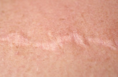 Le cicatrici si curano con la cipolla, ecco come