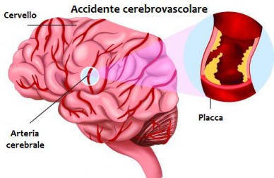 Ictus: come riconoscerne i sintomi