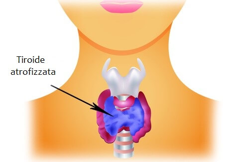 Caso di ipotiroidismo