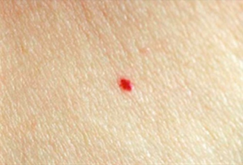 Nei rossi sulla pelle