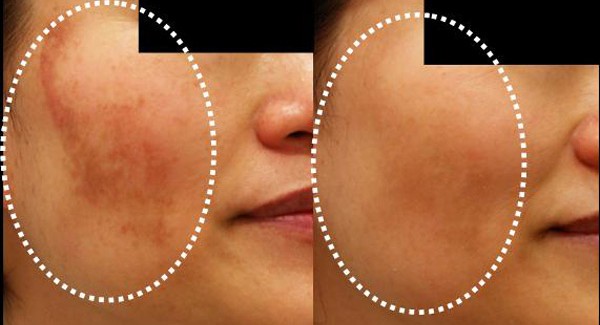 Trattamento naturale per il melasma Trattamento naturale per il melasma