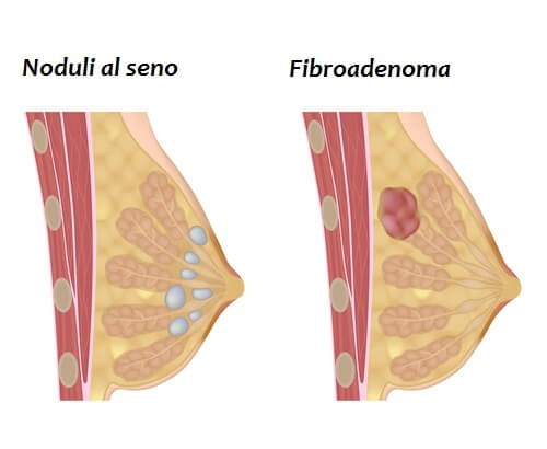 noduli al seno e fibroadenoma