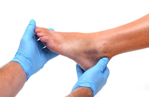 Gonfiore alle caviglie e ai piedi: cause e prevenzione