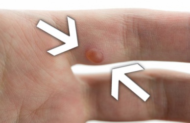 Eliminare le verruche in maniera naturale