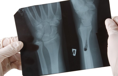 Rafforzare le ossa con il calcio di origine vegetale