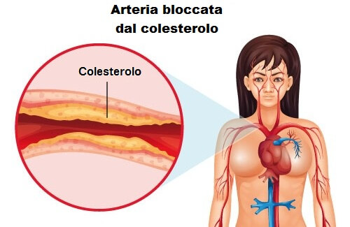 Cosa fare per tenere sotto controllo il colesterolo