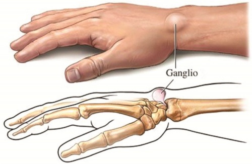 Cisti gangliare