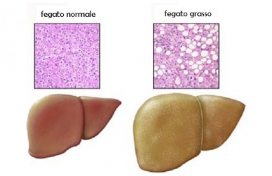 Steatosi o fegato grasso: alimenti da evitare