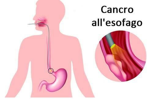 Malattie dell'esofago i sintomi delle principali malattie