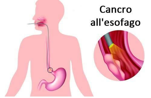 Malattie Dellesofago I Sintomi Delle Principali Malattie