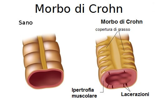 Morbo di Crohn: quali sono i sintomi e le terapie