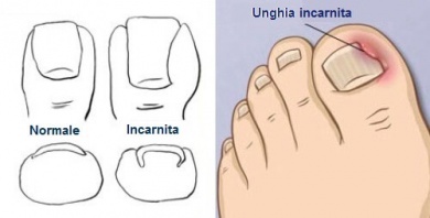 Rimedi per le unghie incarnite: quali sono?
