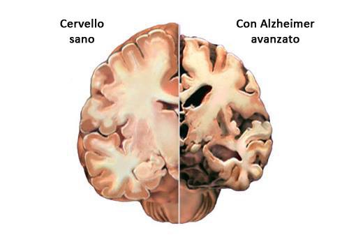 Alzheimer cervello