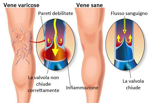 le vene varicose sono dovute a una cattiva circolazione sanguigna