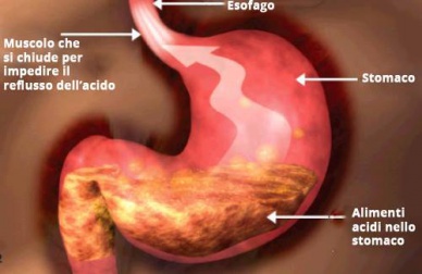Reflusso gastrico: la dieta adatta per alleviarne i sintomi