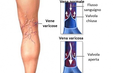 Trattamento delle vene varicose con piante medicinali