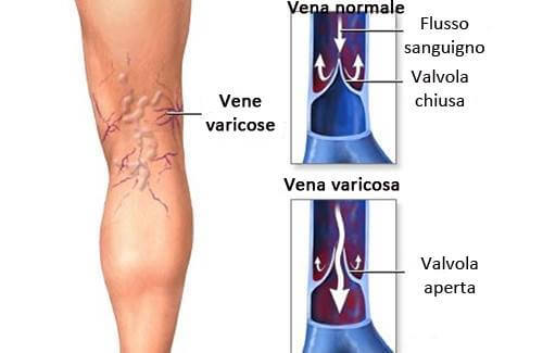 Vene varicose