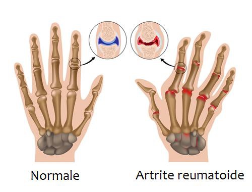 Combattere i sintomi dell'artrite