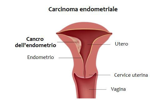 Il carcinoma endometriale è un tipo di cancro che si sviluppa a partire dall'endometrio, cioè il rivestimento o lo strato più interno dell'utero.