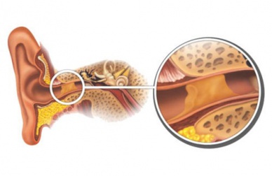 Tappi di cerume: come rimuoverli in modo naturale