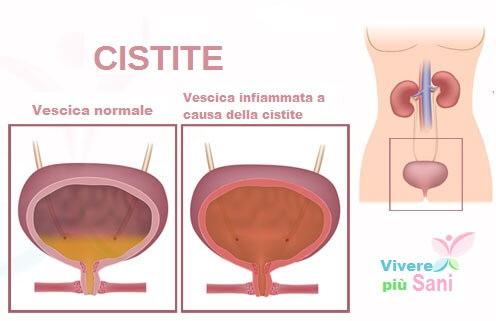 Cistite