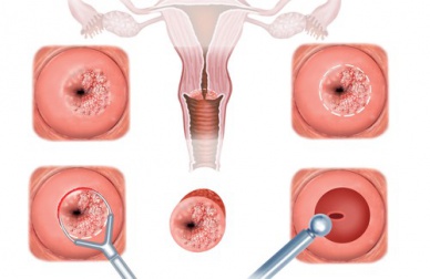 Sintomi e trattamento della cervicite