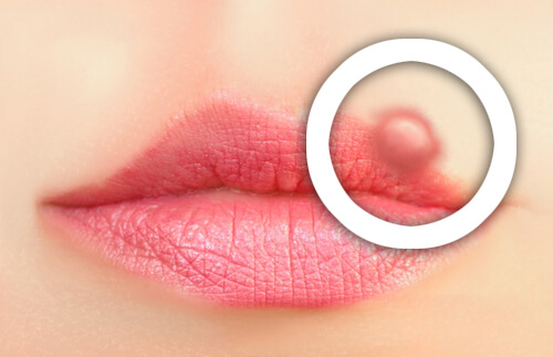Herpes alle labbra: come prevenirlo?