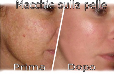 Eliminare le macchie sulla pelle con rimedi semplici