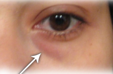 Trattamenti casalinghi per eliminare le occhiaie