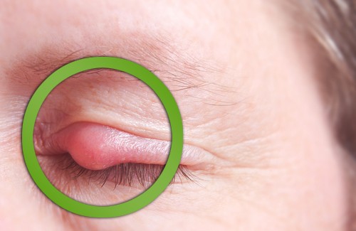 10 rimedi naturali per curare l'orzaiolo