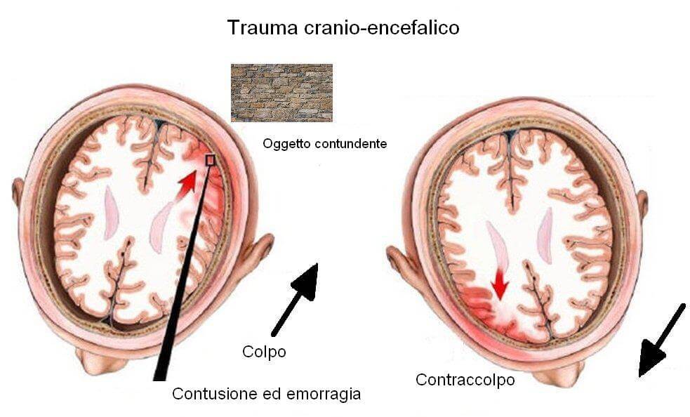 trauma cranico