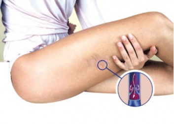 Consigli, trucchi e rimedi contro le vene varicose