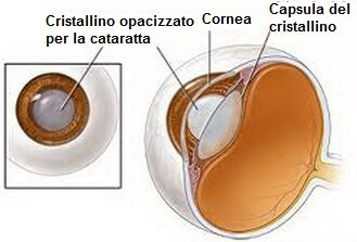 Cataratta
