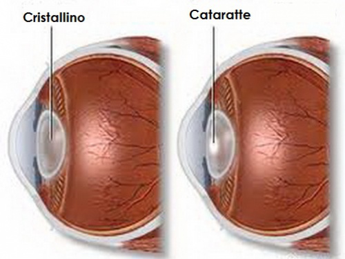 Immagine cataratte