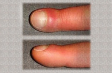 Perché si gonfiano le dita delle mani?