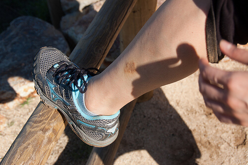 Come eliminare un eczema