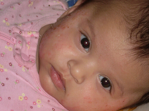 Bambina con eczema in viso