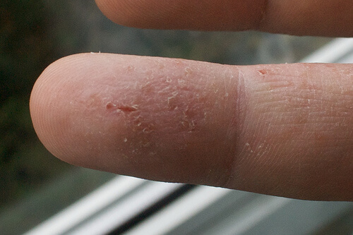 Dito con eczema
