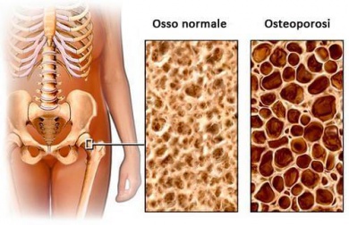 Dieta per evitare l’osteoporosi