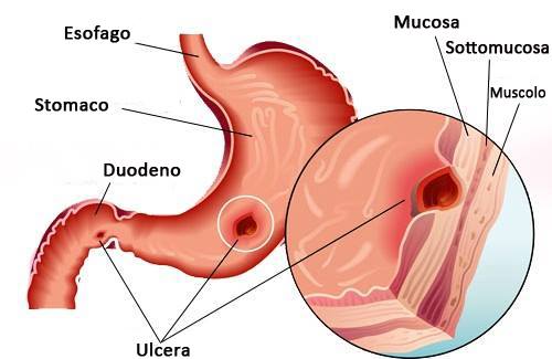 Ulcere allo stomaco: trattamenti naturali